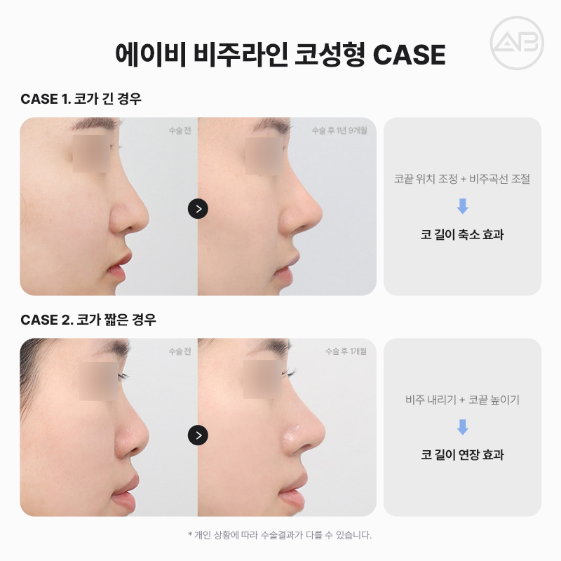 자려한비주라인코성형 AB성형외과에서 완성해보세요 관련 이미지 4
