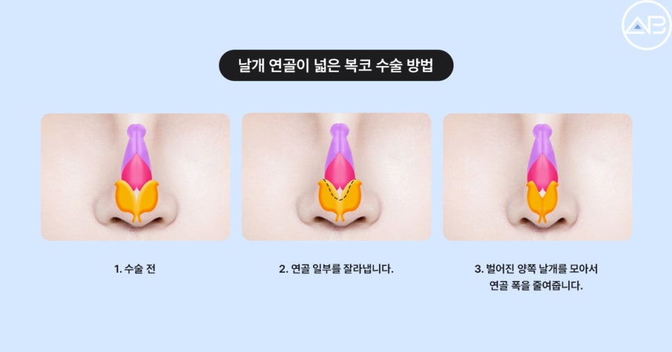 복코성형 전후효과 보려면? (Faet. 에이비성형외과 서찬얼원장) 관련 이미지 4