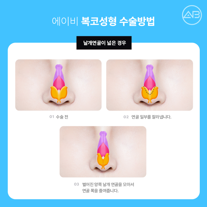 Why AB Plastic Surgery Is Famous for Bulbous Nose Surgery image 3