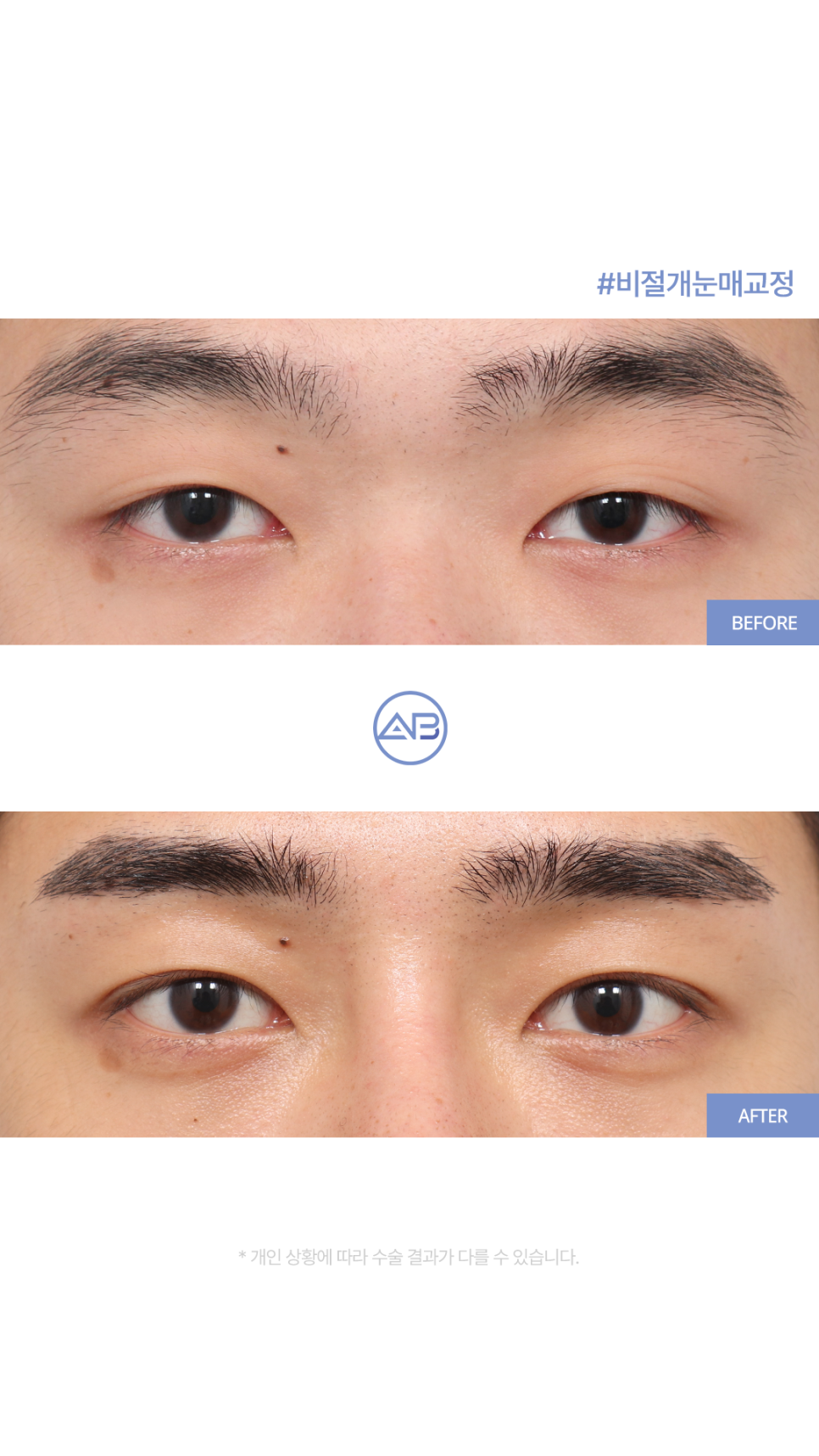 AB성형외과 남자눈매교정 수술전후 관련 이미지 6