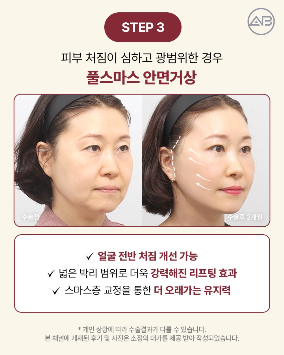 AB Plastic Surgery: Aging-Specific Step-by-Step Lifting (Mini Lift, Semi-Full Lift, Full SMAS Facelift) image 4