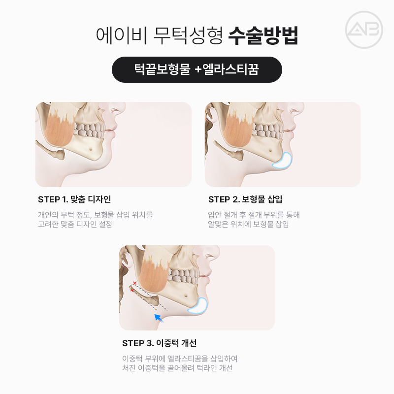 무턱성형 고려하고 있다면 AB성형외과 관련 이미지 9