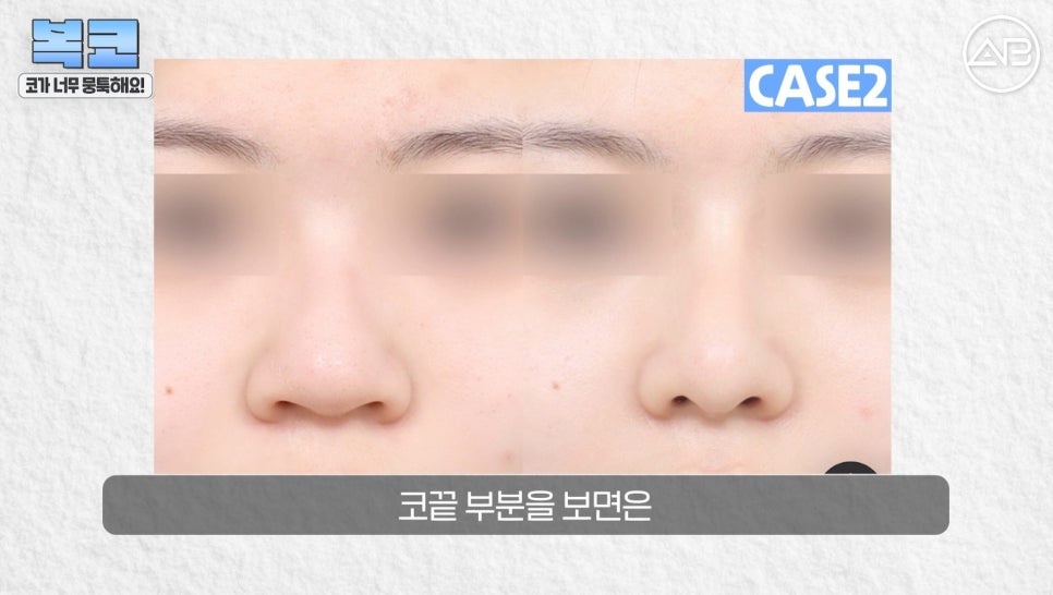 #에이비성형외과#에이비tv#코성형#복코성형 관련 이미지 17