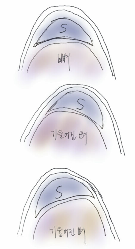 Q. 휜코 교정 후 여전히 코가 휘어 있으면 재수술해야 할까요? 어떻게 수술해야 하나요? 관련 이미지 1