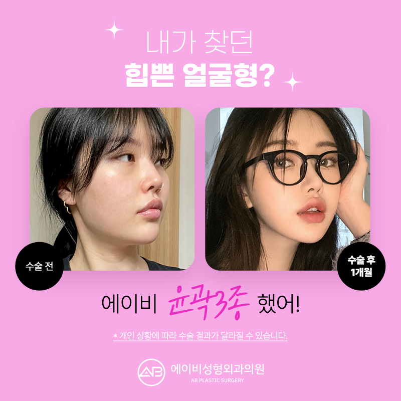 윤곽수술잘하는곳 볼 때 고려해야 할 점 관련 이미지 2