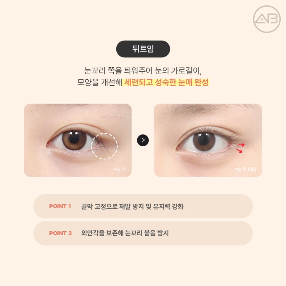 AB Plastic Surgery Eye Corner Surgery: Types and Reviews of Epicanthoplasty, Canthoplasty, and Lower Canthoplasty image 4