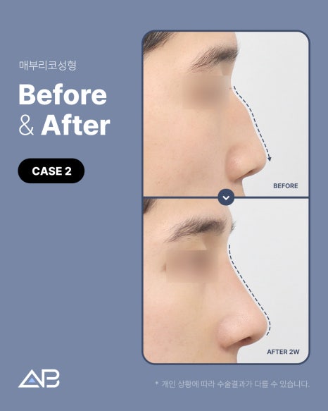 매부리코성형 자연스럽게 교정 원한다면 AB성형외과 관련 이미지 5