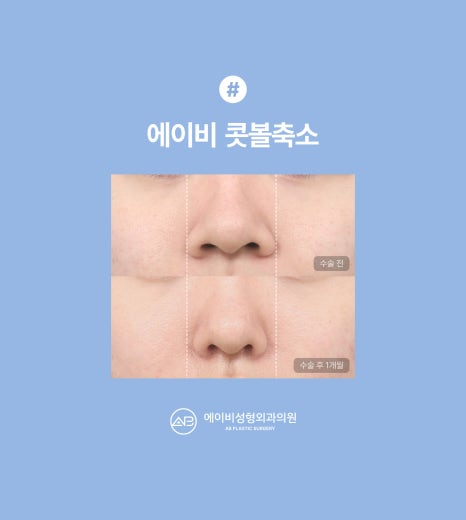 에이비성형외과 콧볼축소 수술전후 관련 이미지 5