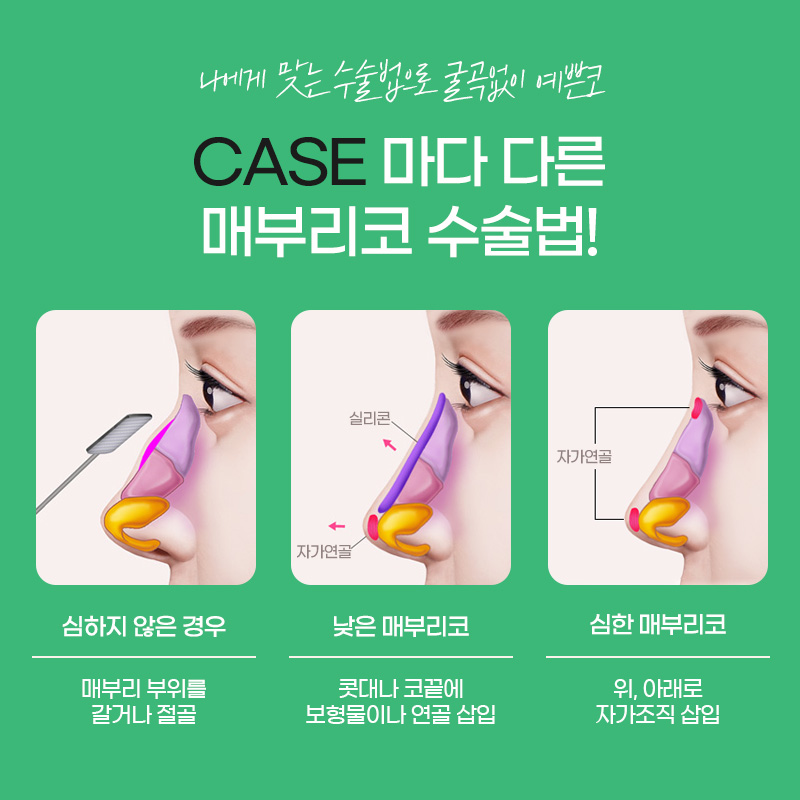 매부리코교정 에이비에서 자연스럽게 관련 이미지 4
