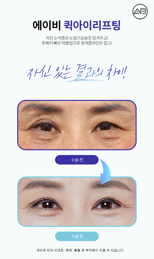 중년눈성형 퀵아이리프팅 하나면 끝 관련 이미지 3