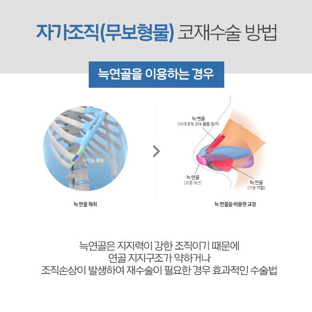 코재수술비용 고민이라면 AB성형외과에서 알아봐 관련 이미지 8