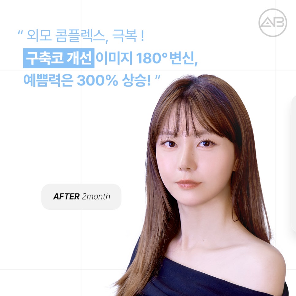 AB Plastic Surgery Contracted Nose Autologous Rib Short Nose Revision Correction Before and After image 4