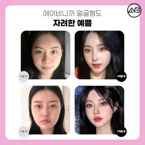 자려한안면윤곽 원한다면 AB성형외과 관련 이미지 5