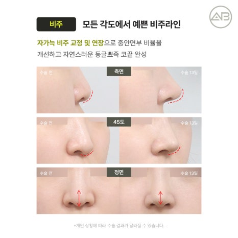 에이비성형외과 자가늑연골 비주라인 코재수술 시기와 교정 체크포인트 관련 이미지 12