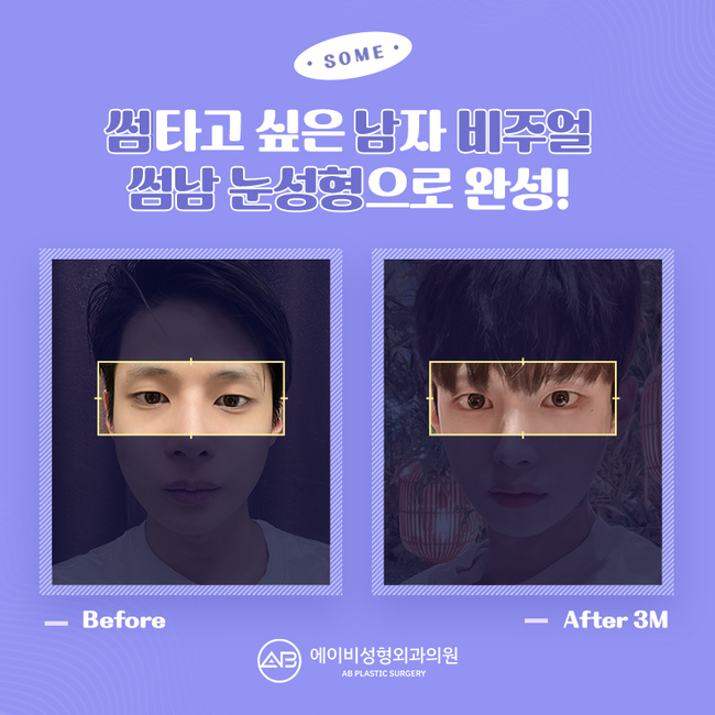 에이비성형외과 썸남눈성형 이게 뭔데? 관련 이미지 2