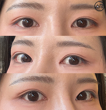 비절개눈매교정+앞트임+뒤트임+밑트임 성형케이스 리뷰 관련 이미지 7
