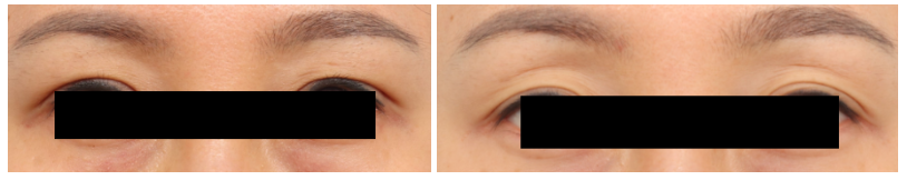 [Column] Can Sunken Eyelids Be Improved Too? image 5