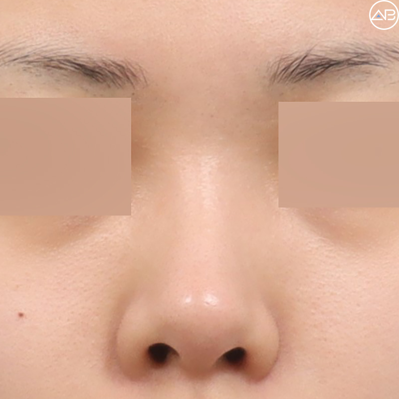 AB Plastic Surgery Natural Glamorous Rhinoplasty Case Review (Feat. Dr. Jo Gyu-sang) image 1