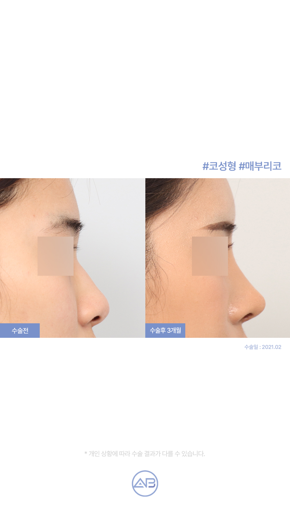 에이비성형외과 자려한코성형 수술전후 관련 이미지 3