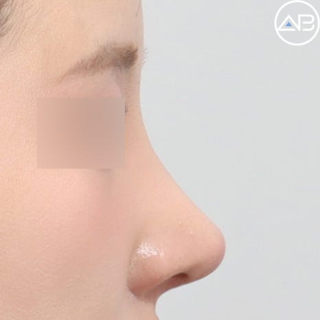 AB Plastic Surgery Low Nose Rhinoplasty Case Review (Feat. Director Seo Chan-eol) image 4