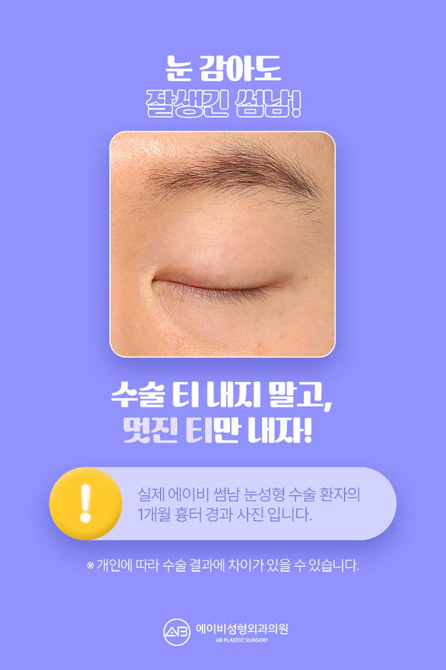 에이비성형외과 썸남눈성형 이게 뭔데? 관련 이미지 6