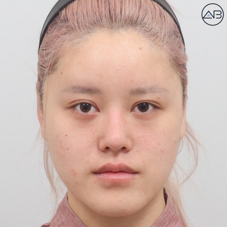 에이비성형외과 양악+윤곽수술(사각턱 턱끝) 케이스 리뷰 관련 이미지 1