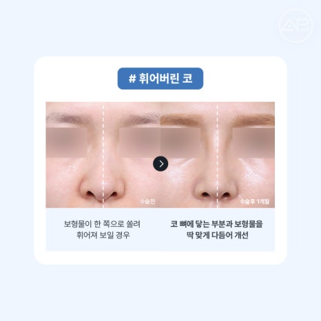 코재수술 필요하다면 에이비성형외과 관련 이미지 3