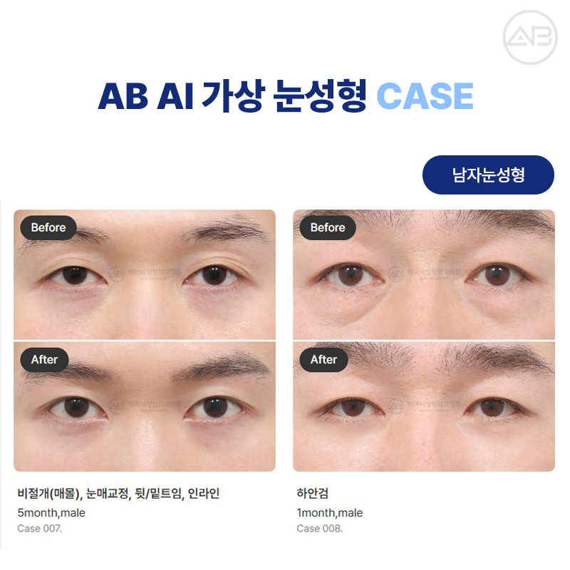 에이비성형외과 AI 가상 눈성형 원하는 결과를 미리 볼 수 있다! 관련 이미지 5