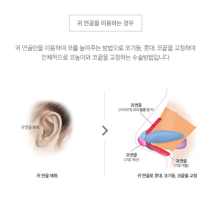 무보형물코수술잘하는곳 에이비성형외과는 어때? 관련 이미지 4