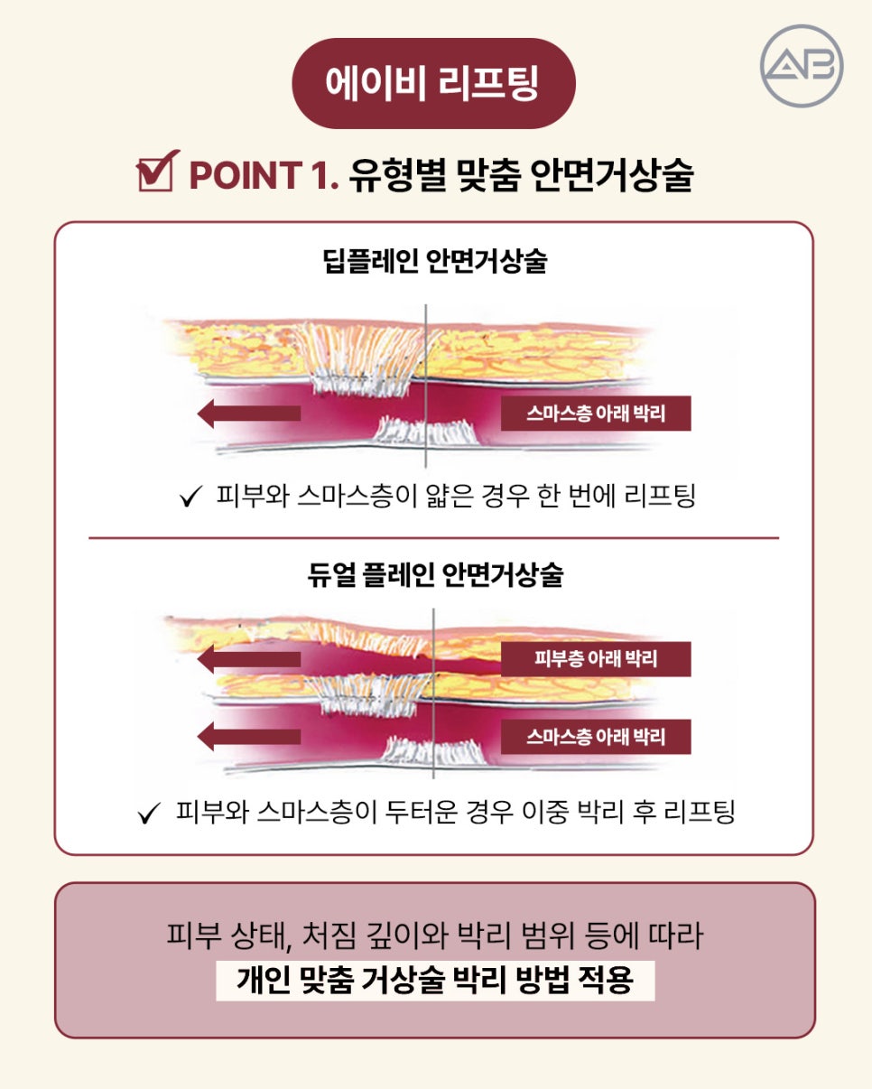 AB Plastic Surgery: Aging-Specific Step-by-Step Lifting (Mini Lift, Semi-Full Lift, Full SMAS Facelift) image 5