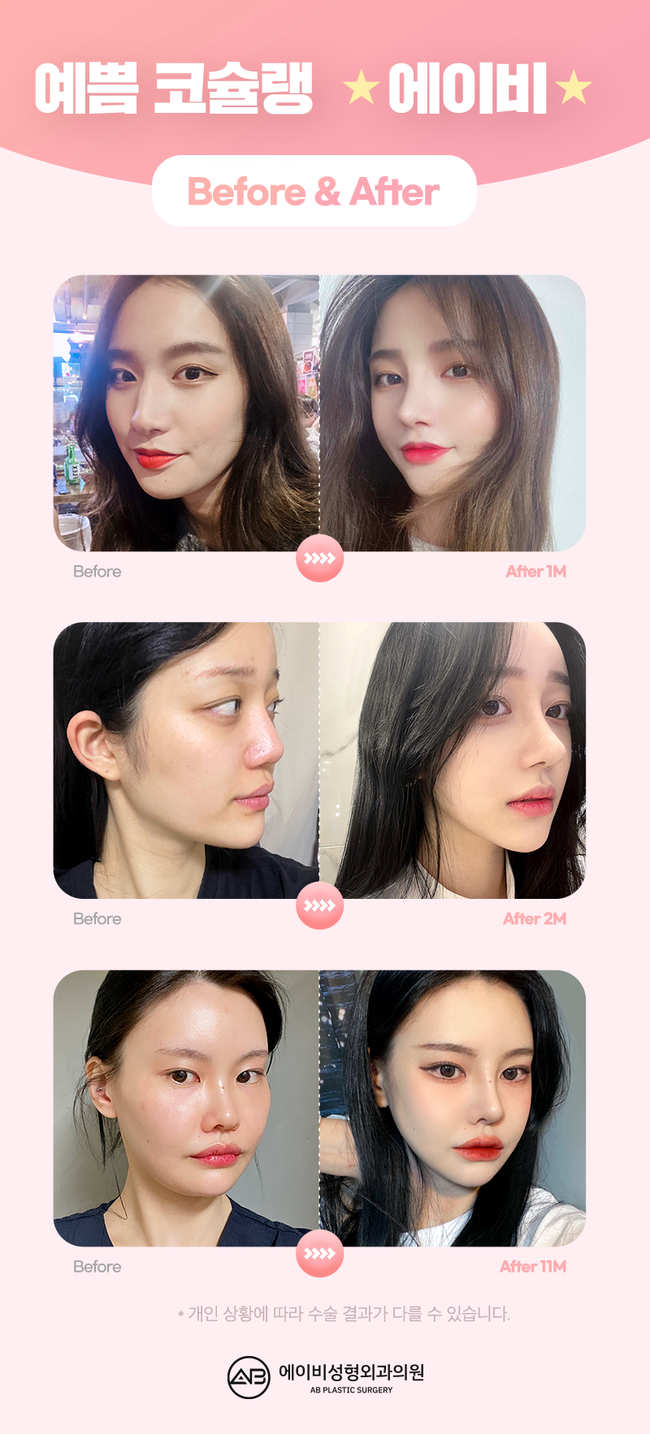 코수술붓기 빠른 회복을 위한 방법은? 관련 이미지 4