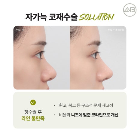 에이비성형외과 자가늑연골 비주라인 코재수술 시기와 교정 체크포인트 관련 이미지 6