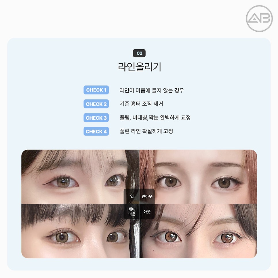 에이비성형외과 쌍꺼풀 짝눈 눈재수술종류 전후 관련 이미지 7