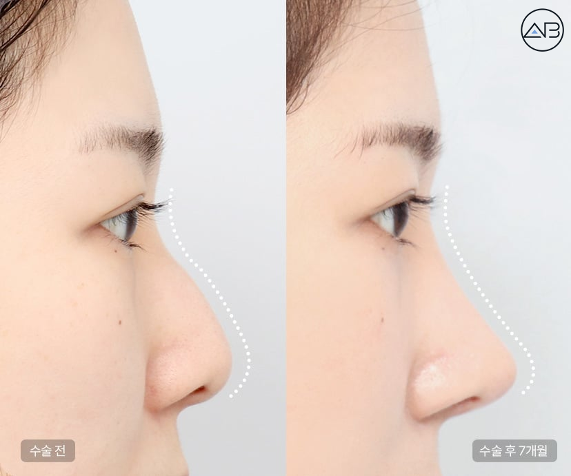 Learn About and Decide on AB Plastic Surgery’s Hump Nose Correction and Implant-Free Rhinoplasty image 1