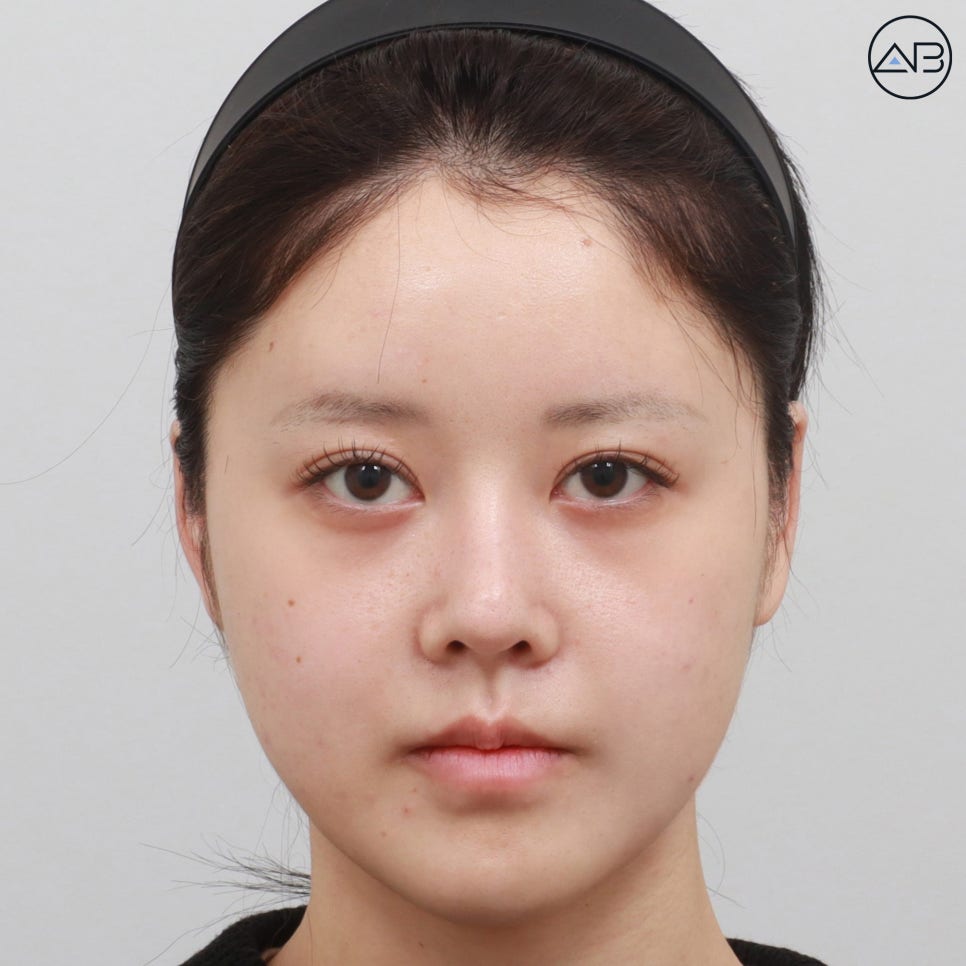 에이비성형외과 양악+윤곽수술(사각턱 턱끝) 케이스 리뷰 관련 이미지 3