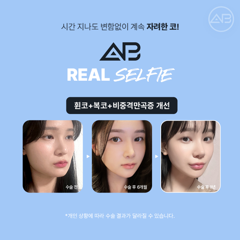 코재수술 필요하다면 에이비성형외과 관련 이미지 12