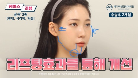 #에이비성형외과#에이비tv#케이스리뷰#안면윤곽성형 관련 이미지 6
