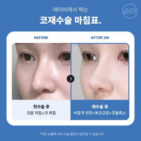 코재수술 필요하다면 에이비성형외과 관련 이미지 10