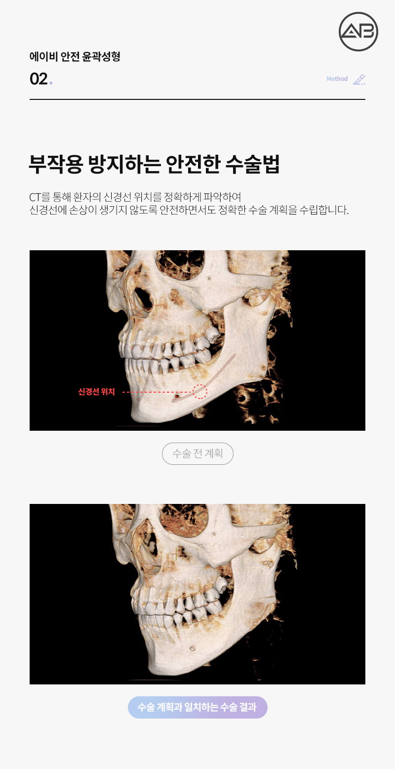 AB Plastic Surgery Facial Contouring Safety System image 3