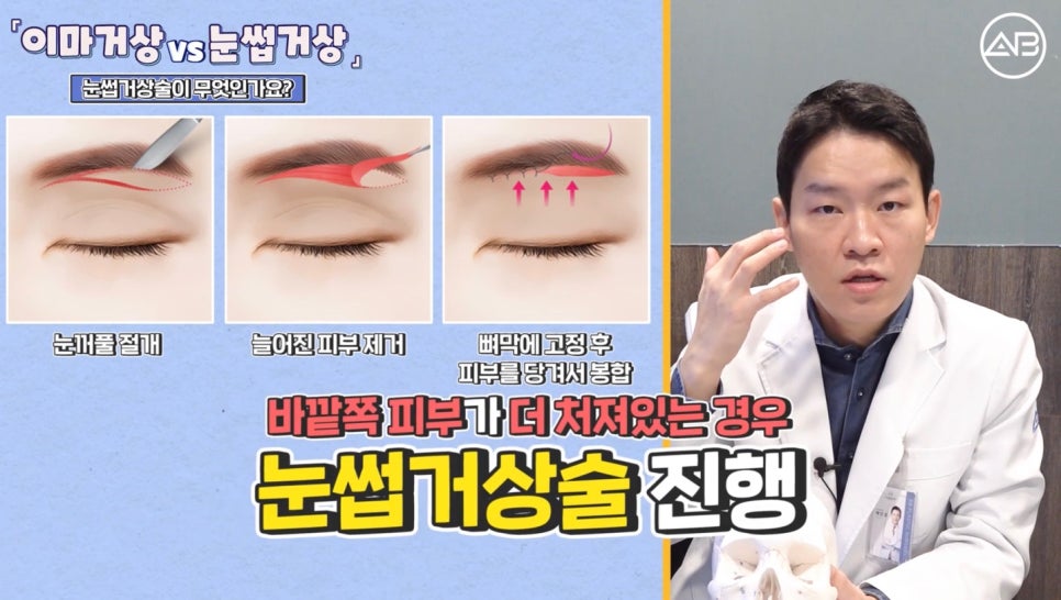 #AB Plastic Surgery #AB TV #Forehead Lift #Brow Lift image 5