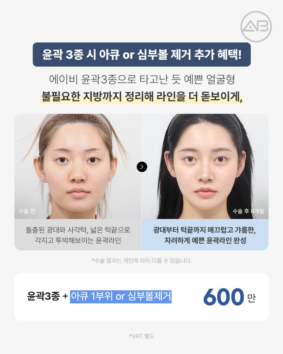 에이비성형외과 추석 기획전 눈밑, 비중격첫코, 윤곽 이벤트 관련 이미지 4