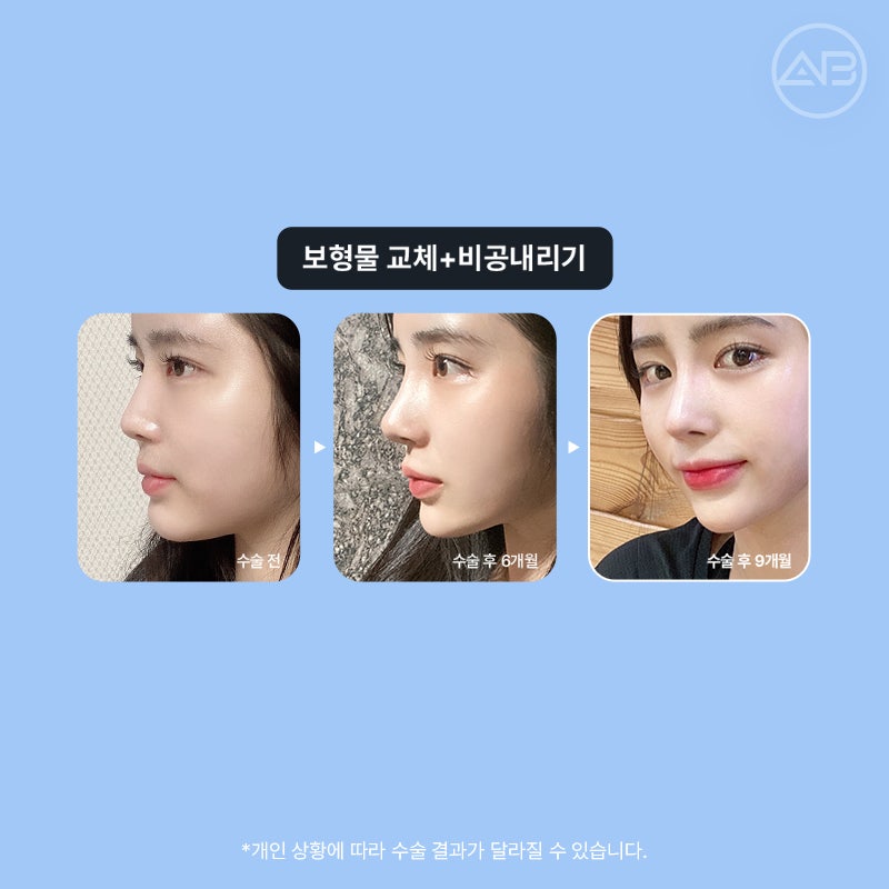 코재수술 필요하다면 에이비성형외과 관련 이미지 15
