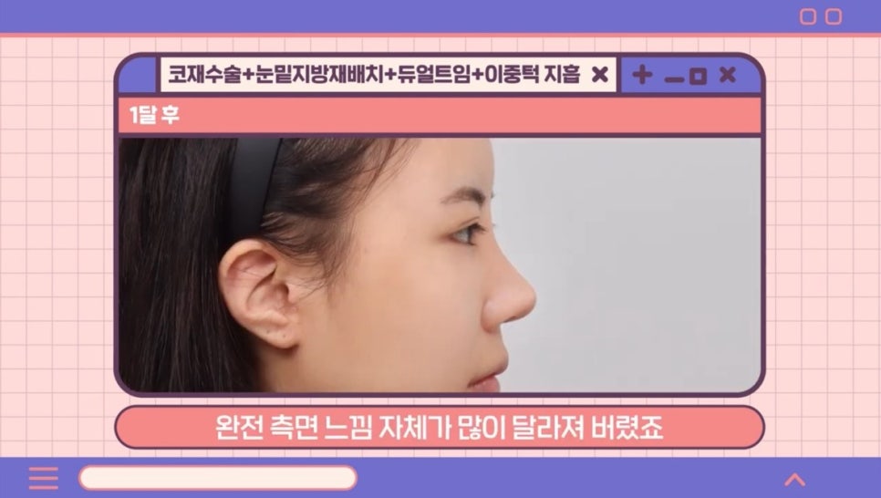 #AB Plastic Surgery #AB TV ##Case Review #Eye Surgery #Nose Revision Surgery image 5