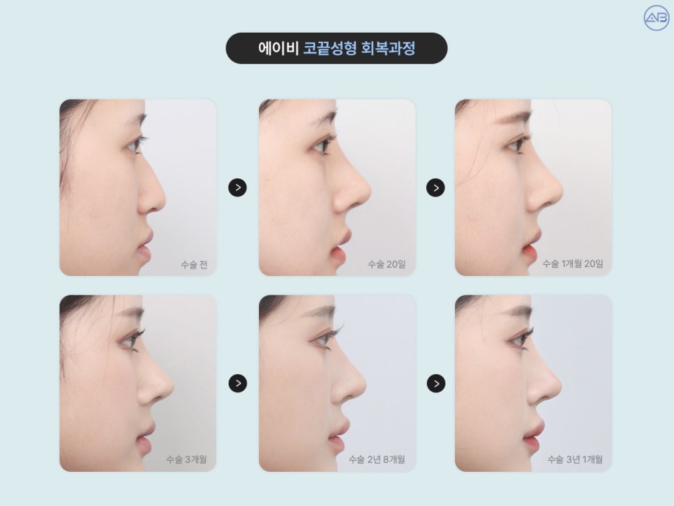 코끝이 낮아지거나 뭉툭해졌다면? 에이비성형외과 코끝 재수술로 바로잡기 관련 이미지 3