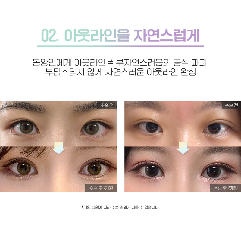 세미아웃눈성형 차이가 있어 관련 이미지 3