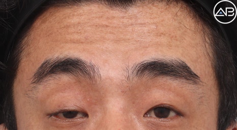 Severe Ptosis: Which Surgery Is Effective? image 1