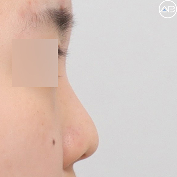 Case Review of Bulbous Nose Surgery That Transformed the Face into a Natural and Refined Look (feat. AB Plastic Surgery) image 2