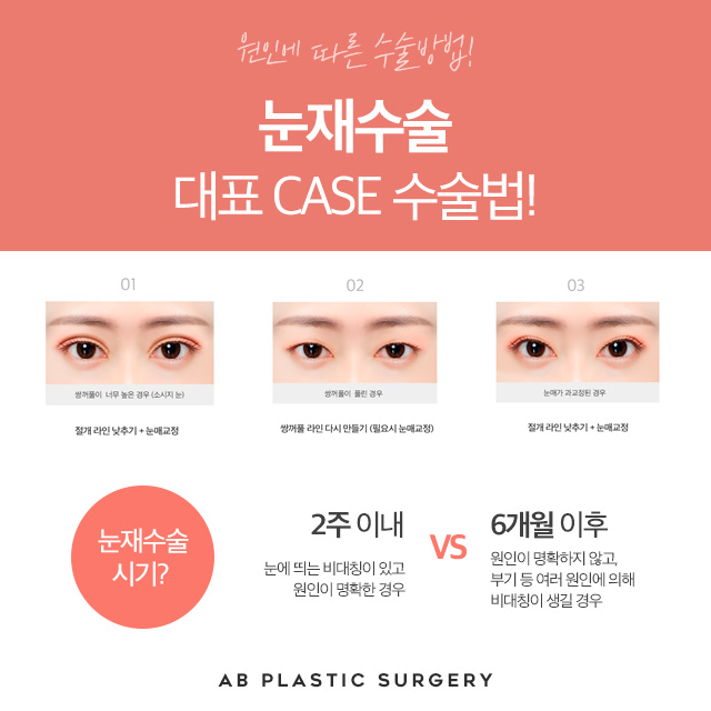 눈재수술잘하는곳 바로 에이비성형외과 관련 이미지 3