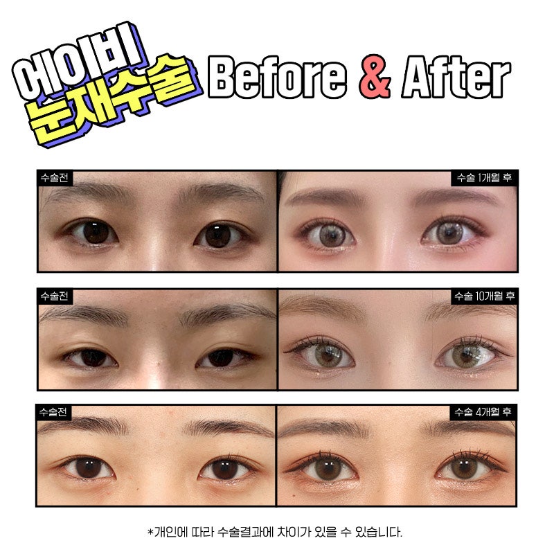 What Is AB Plastic Surgery Like for Double Eyelid Revision Surgery Reviews? image 5