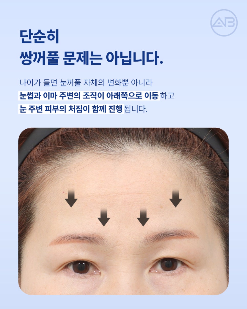 에이비성형외과 눈꺼풀처짐을 바꾸는 이마거상수술의 역할 알아보기 관련 이미지 2